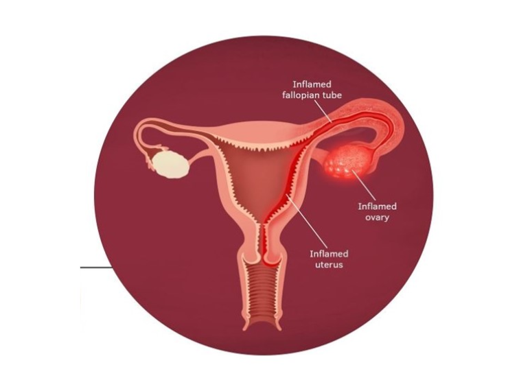 Pelvic Inflammatory Disease Treatment in Hyderabad
