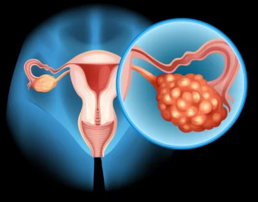 pcos effects on fertility
