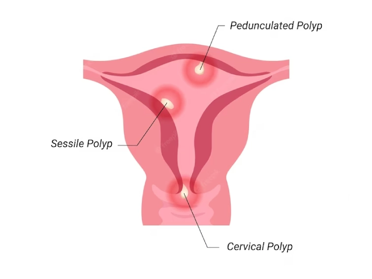 cervical_polyps