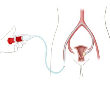 uterine-fibroid-embolization-in-hyderabad