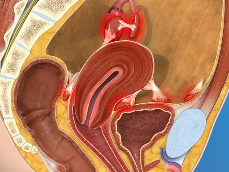 endometriosis treatment